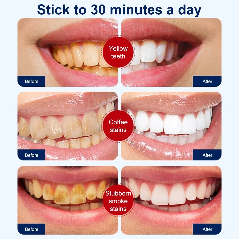5D Teeth Whitening Strips - 7pcs